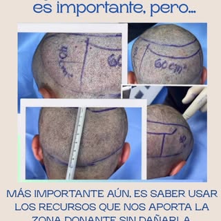 Recuperar el pelo caído es un desafío para el cirujano capilar , debe tenerse en cuenta la densidad 