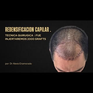 La redensificación capilar es una técnica que te ayudará a mejorar la densidad folicular por centíme