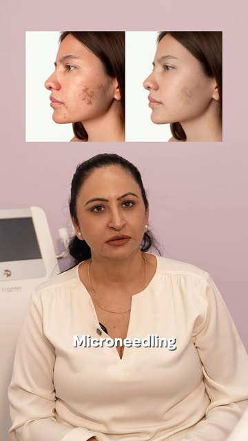 Microneedling can do more than just refresh the skin ✨

It may help improve the appearance of acne s
