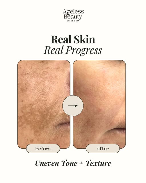 A closer look at real progress in uneven-looking tone and skin texture.

Your treatment plan should 