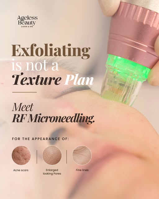 RF Microneedling is a great option for improving the appearance of acne scars, enlarged-looking pore