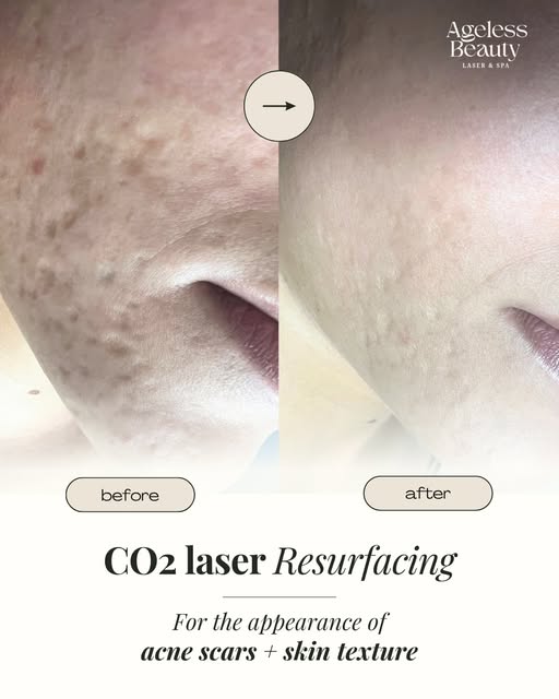 CO₂ Laser Resurfacing can help improve the appearance of acne scars and uneven skin texture.

Book a