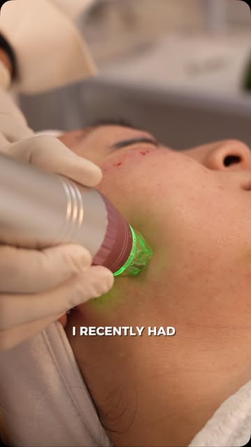 RF Microneedling is a great option for anyone looking to improve the appearance of texture, fine lin