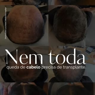 Nem toda queda de cabelo precisa de transplante capilar. ✨

Em muitos casos, quando identificamos a 