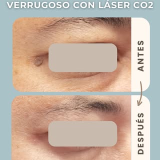 Eliminación de nevus verrugoso con láser CO2 
🔹Se realiza normalmente en una sola sesión 
🔹Utiliza