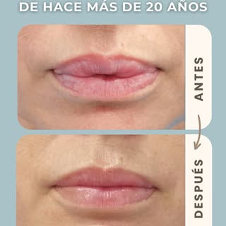 Adiós a un relleno de más de 20 años.

En este caso hemos eliminado quirúrgicamente un relleno perma