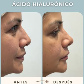 ANTES Y DESPUÉS 
RINOMODELACIÓN con ácido hialurónico 
Nos permite armonizar el rostro, corregir irr
