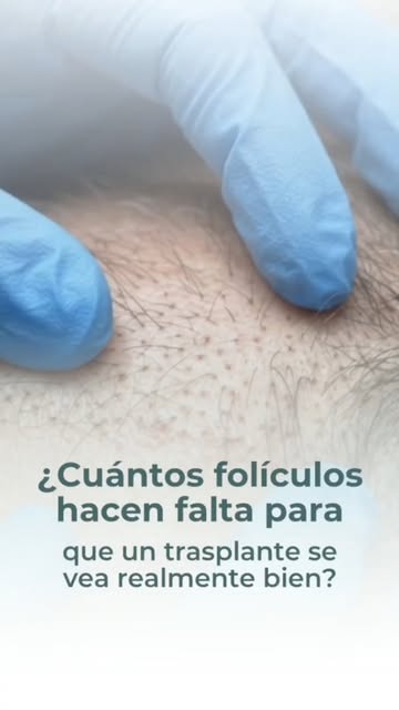 ¿Cuántos folículos hacen falta para que un trasplante se vea realmente bien? 🤔

No hay una cifra un