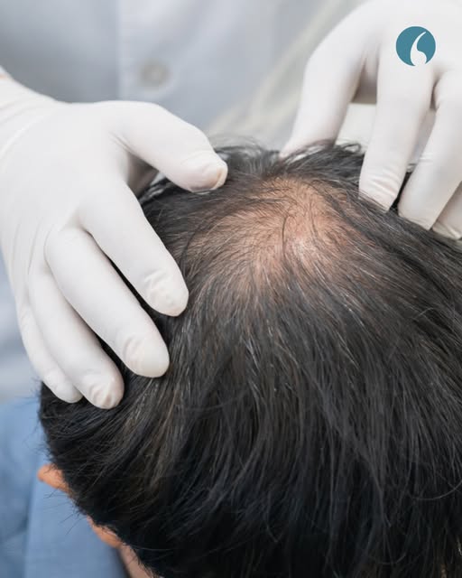 Con la llegada del otoño es habitual notar que el cabello cae más de lo normal. No siempre es una se