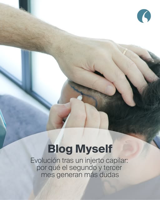 Si te has hecho un injerto capilar y estás en el segundo o tercer mes, es probable que ahora tengas 