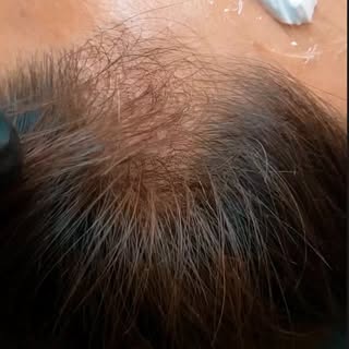 Achieved a fuller and more defined hairline with scalp micropigmentation! This technique creates the