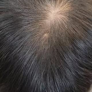Our client came in with concerns about thinning hair at the crown, and after just 3 sessions, we ach