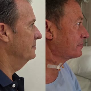 Hay cirugías que rejuvenecen un rostro y otras que cambian por completo un perfil. ✨

Este lifting d