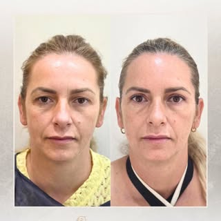 Tus ojos hablan antes que tú. 

Una blefaroplastia superior elimina el exceso de piel de los párpado
