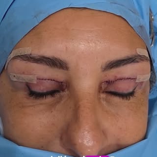 Nuestra técnica más avanzada de rejuvenecimiento de la mirada, realizada con anestesia local y sin e
