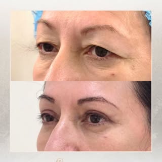 ❌ Si crees que una blefaroplastia consiste solo en quitar piel, este resultado te hará cambiar de op