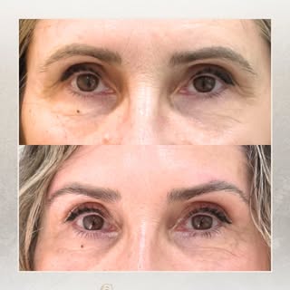 ¿Y si el secreto de una mirada más bonita estuviera en la ceja? 

Un lifting de cejas consigue algo 
