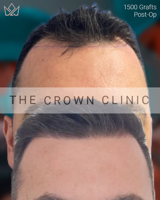 A superbly executed 1500 graft FUE procedure at The Crown Clinic showcases the level of precision an