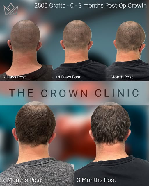 In the first 0–3 months after an FUE procedure, the donor area begins its natural recovery process. 