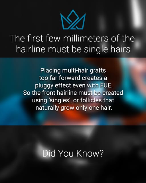 The transition zone at the very front of the hairline is critical. Naturally, the leading edge of a 