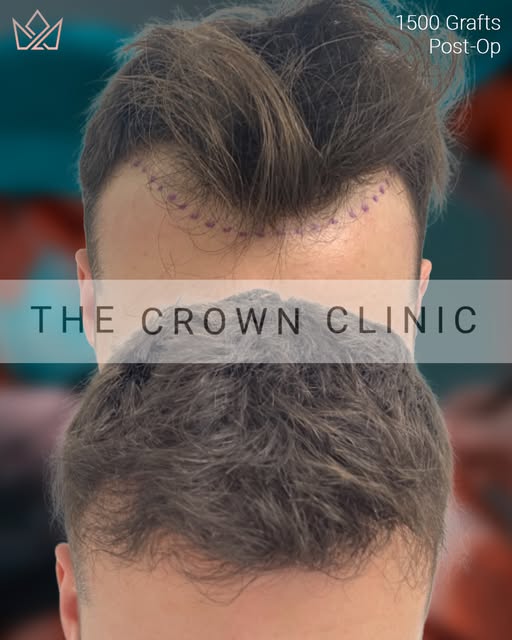 A carefully performed 1500 graft FUE procedure at The Crown Clinic is about thoughtful design as muc