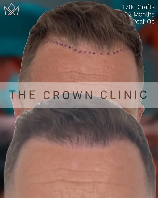 A fantastic hairline restoration result from a 1200 graft FUE procedure at Crown Clinic⁠
⁠
This pati