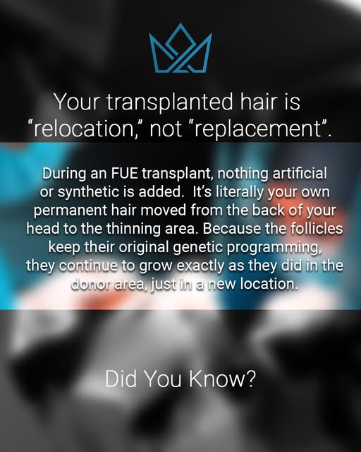During an FUE transplant, nothing artificial or synthetic is added — it’s literally your own permane