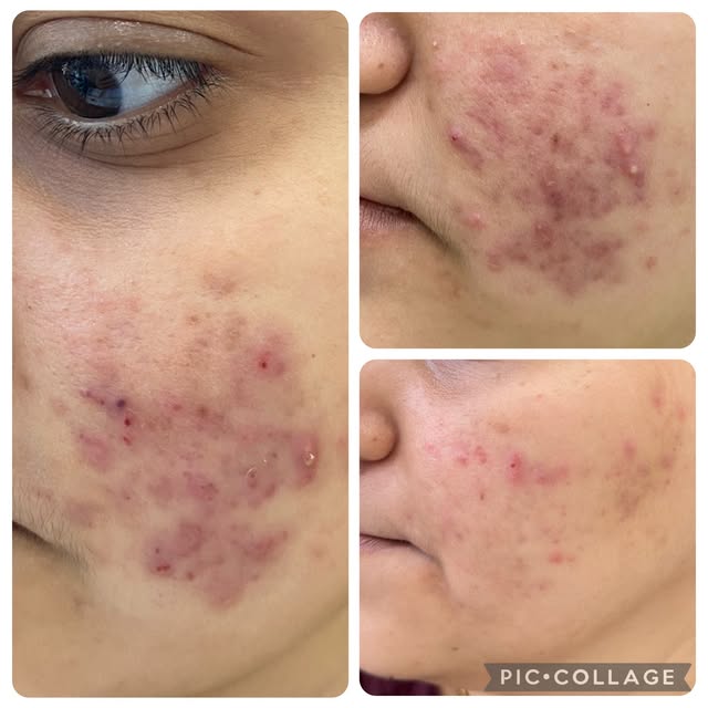 Can u expect your acne to clear out quickly once u start the treatment?
Doctor, how quick can the sk