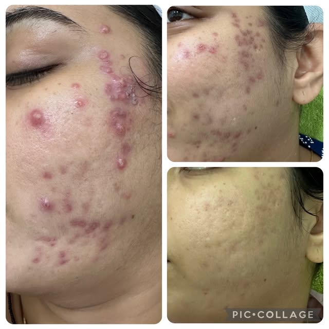 Is Acne only a skin concern?? 
Is it ok to just treat what you see on the skin?

If your skin has so