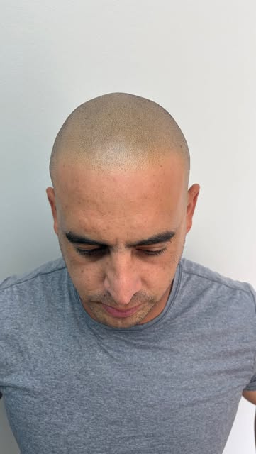 NORWOOD 7 TRANSFORMATION 🔥

From advanced hair loss to the appearance of a full head of freshly sha
