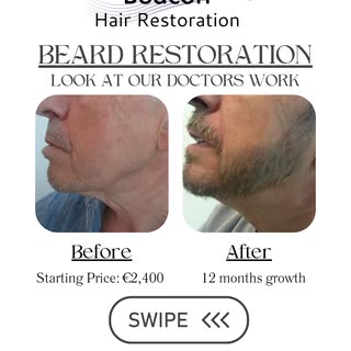 Message us for a Free Beard Consultation Monday to Friday in our Sandyford Clinic!