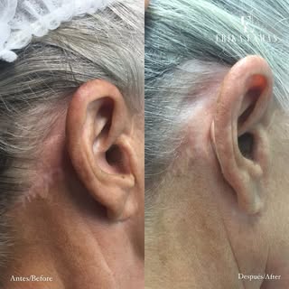 SCAR CAMOUFLAGE/ CAMUFLAGE DE CICATRICES ✨

Using permanent makeup techniques, scar camouflage tatto