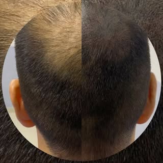 😒 ¿No te gusta verte sin cabello?
🧢 ¿Te gustaría dejar de usar gorra?
😎 ¿Te gustaría verte 10 año