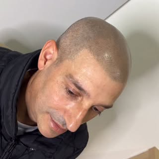 Se você está calvo há anos e acha que vou resolver sua calvície de um dia para o outro…. Você ta com
