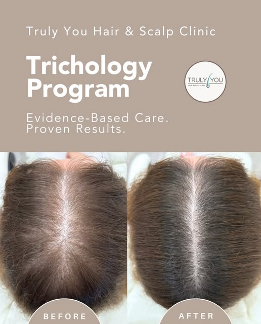 👏 PROGRESS WORTH CELEBRATING! 

This client came to #TrulyYouHair with Female Pattern Hair Loss (An