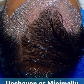 No shaving, no downtime, no cover-ups. Get a fuller hairline without letting the world know you had 