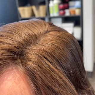 A hair loss transformation is more than just a change in appearance — it’s a restoration of confiden