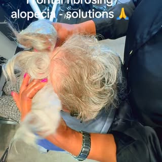 Frontal Fibrosing Alopecia (FFA) Transformation ✨

Frontal Fibrosing Alopecia is a form of scarring 
