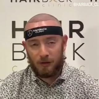 🇫🇷 Résultat greffe capillaire par HairBack Clinic 🔝 🇹🇷 Greffe de cheveux en Turquie ⭐️

🇪🇸 Re
