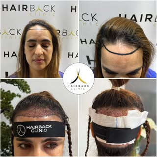 🇫🇷 Greffe de cheveux pour femme 👩🏻 Greffe de cheveux sans raser ⭐️

🇪🇸 Trasplante de cabello p