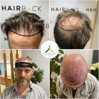 🇫🇷 Greffe de cheveux en 2 sessions ✨ avec HairBack Clinic ⭐️

🇪🇸 Trasplante capilar en 2 sesione