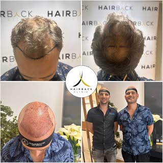 🇫🇷 Une greffe de cheveux entre amis ? C'est possible avec HairBack Clinic 🤩

🇪🇸 ¿Un trasplante 