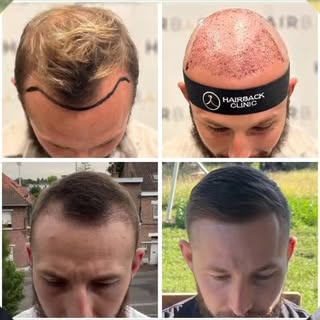 🇫🇷 Témoignage et Résultat greffe capillaire après 12 mois 🔝 🇹🇷 Greffe de cheveux en Turquie ⭐️
