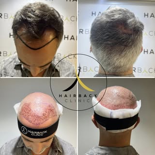 🇫🇷 Greffe de cheveux en Turquie, à partir de 2090€ - avec les meilleurs équipes et les meilleures 
