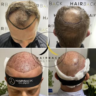 🇫🇷 Re-densification capillaire grace à la greffe de cheveux FUE Saphir 🤩🔝

🇪🇸 Redensificación 