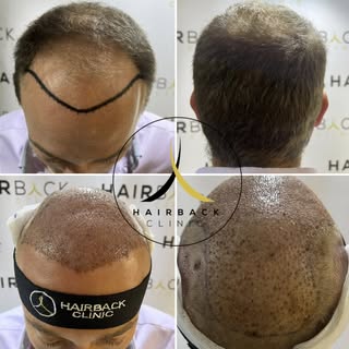 🇫🇷 Perte de densité capillaire ? Optez pour la greffe de cheveux avec HairBack Clinic. La meilleur