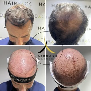 🇫🇷 Re-densification capillaire grace à la greffe de cheveux FUE Saphir 🤩🔝

🇪🇸 Redensificación 