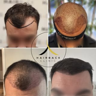 🇫🇷 Résultat greffe de cheveux après 9 mois - HairBack Clinic, la meilleure clinique de greffe de c