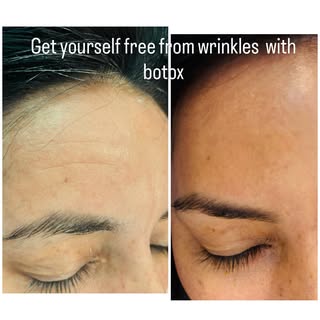 Botox is non invasive treatment for wrinkle