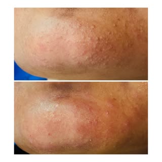 SAY BYE TO BLACKHEADS & WHITEHEADS 👋

HydraFacial Deep Cleansing Treatment

Deep cleanse • Extract 